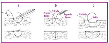 Tipos de suturas para cierre cutáneo