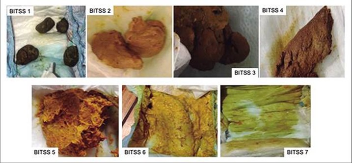 Escala BITSS - Brussels Infant and Toddler Stool Scale